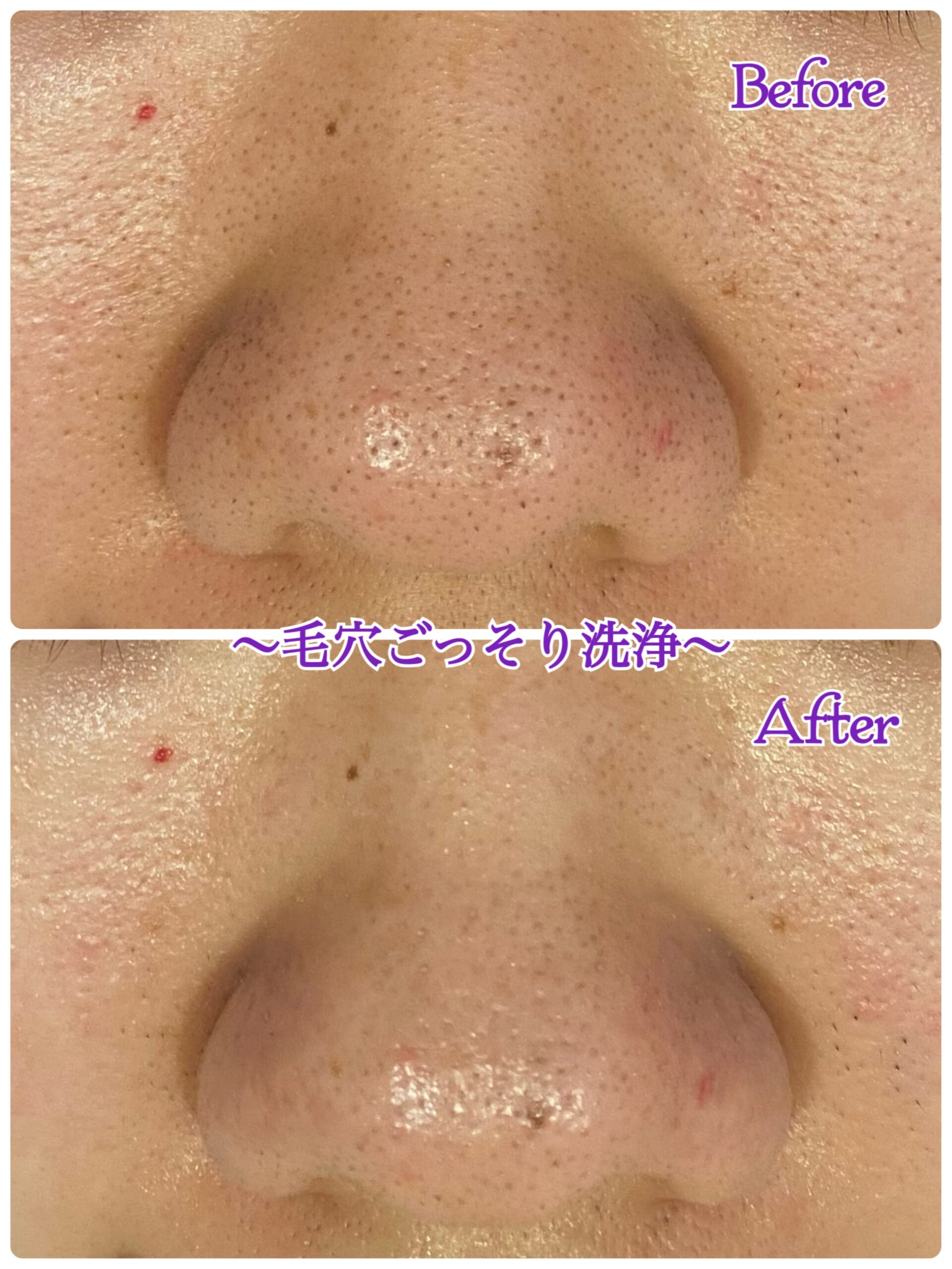 ✳︎毛穴ごっそり洗浄✳︎Before・After 症例写真 | 敏感肌も美肌に